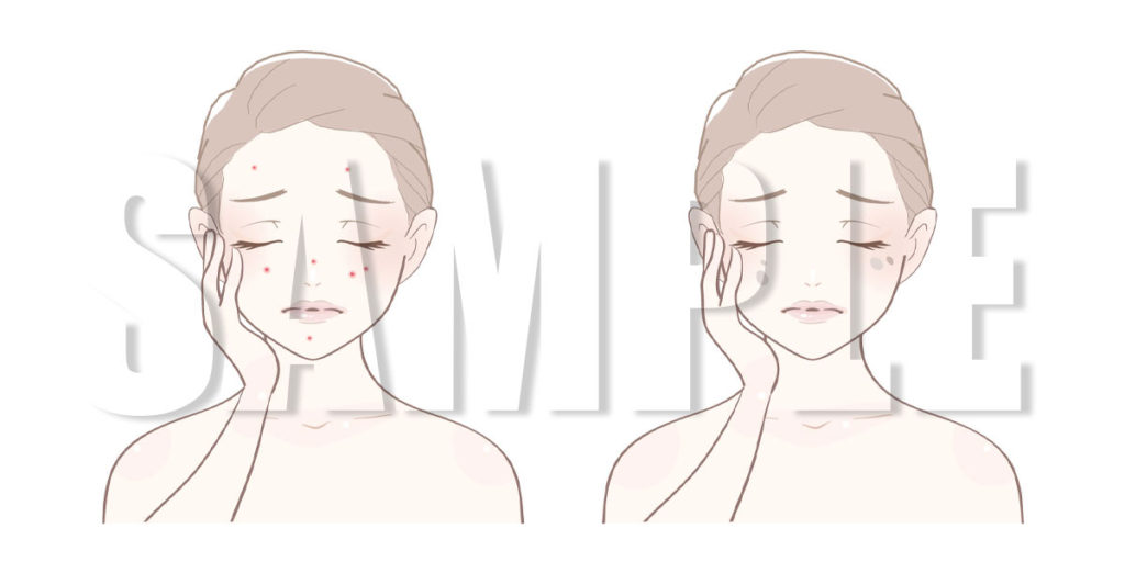 【無料】ニキビ・シミのイラスト